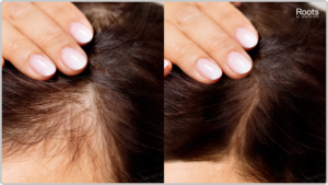 The onset of androgenetic alopecia