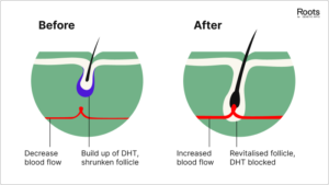 Minoxidil increases blood flow