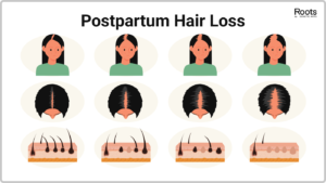 Female hair thinning stages